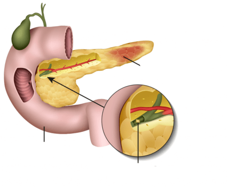 la pancreatitis es una inflamación del páncreas